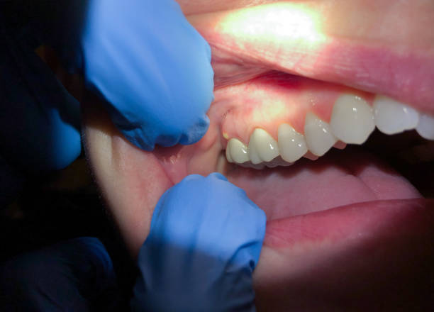 Best Emergency Tooth Extraction in Cashion, OK
